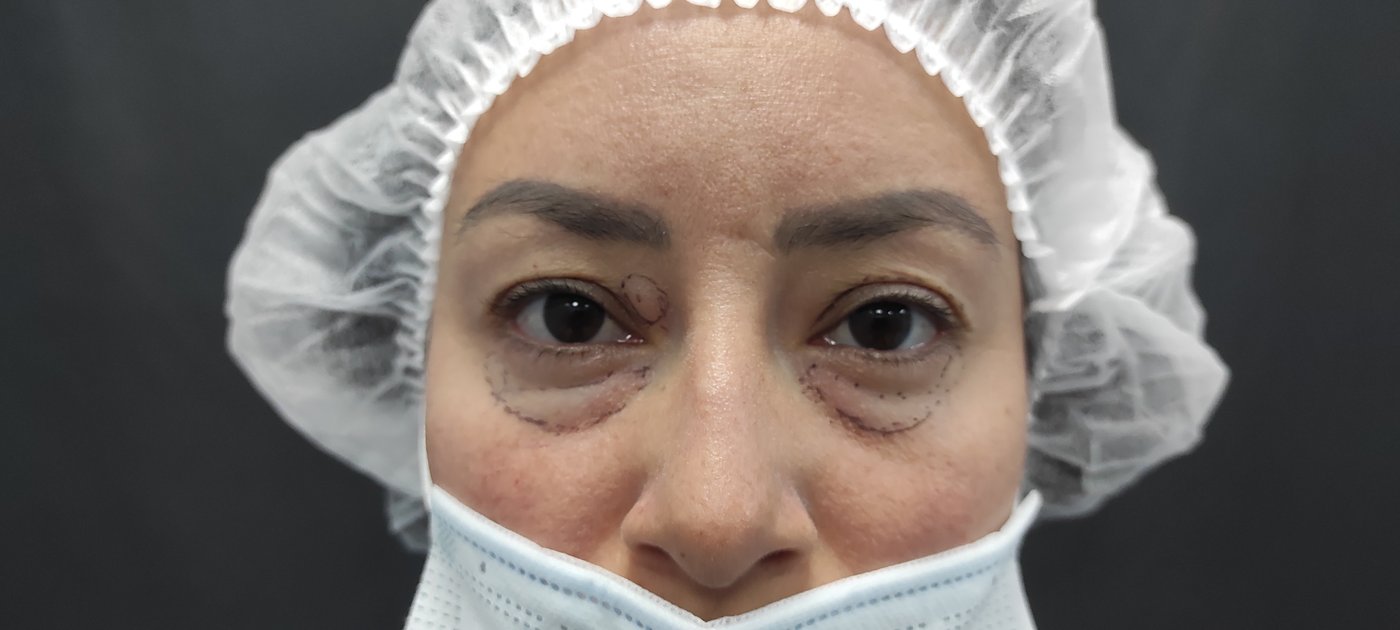 Blefaroplastia laser - antes - Dr. Gomez Bogota