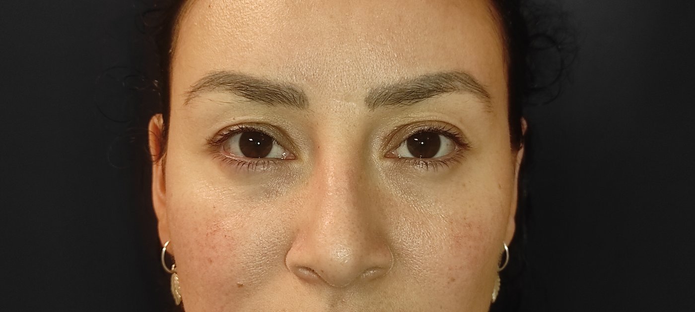 Resultado blefaroplastia láser Dr. Gómez Bogotá — párpados superiores e inferiores