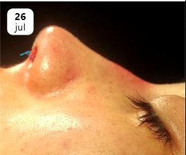 Antes rinoplastia Dr. Gómez