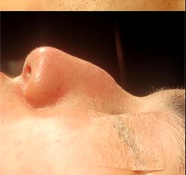 Rinoplastia ultrasónica